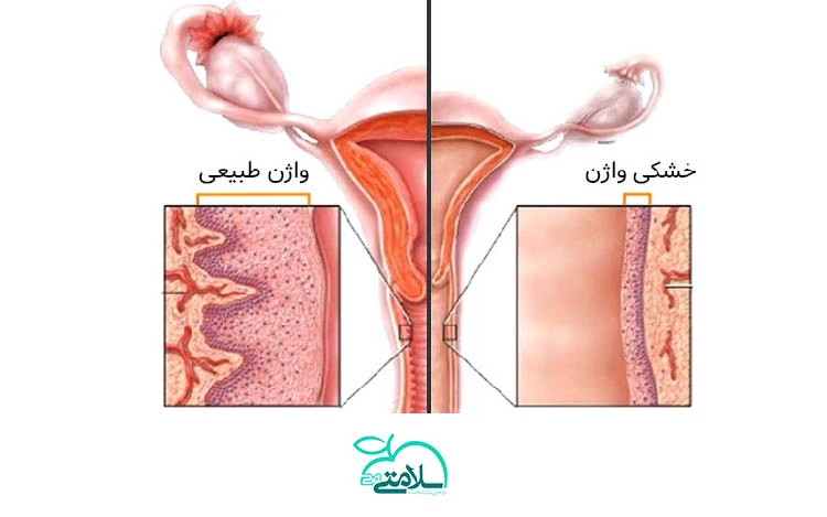 همه چیز درمورد آتروفی واژن